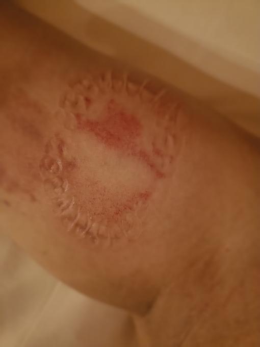 YUMA（ユマ） 【噛み跡③】