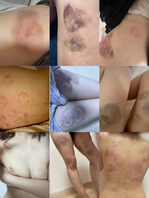 YUNO(ユノ) 噛み跡集🦷