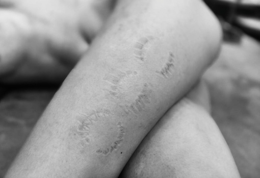 YUMA（ユマ） 噛み跡⑤