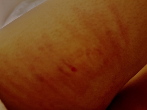 SHUNSUKE こういう痕もやってるよ。何で付けてるかはお楽しみ🤫