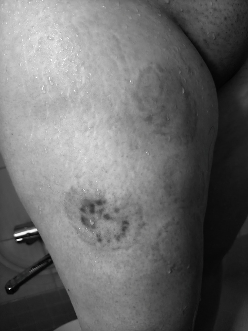 YUMA（ユマ） 噛み跡⑥