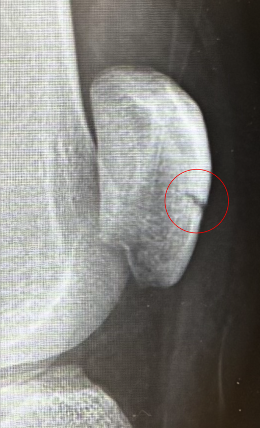 TAKUMI（タクミ） 膝の骨折から2週間、、、