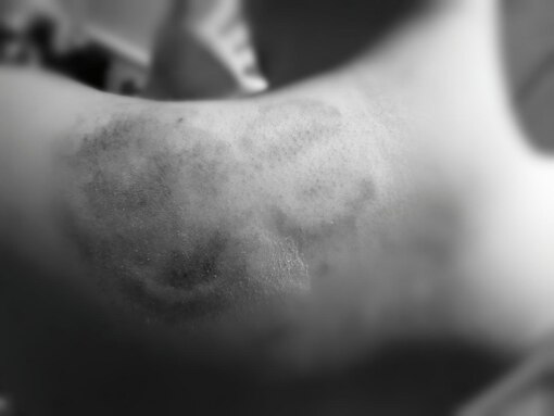 YUMA（ユマ） 噛み跡⑦