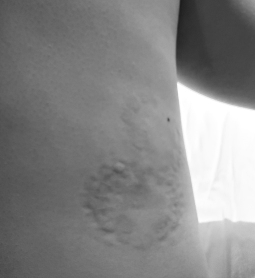 YUMA（ユマ） 噛み跡⑧