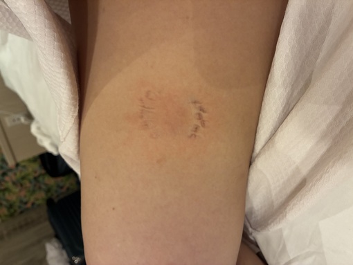 TSUMUGI（ツムギ） 噛み跡の経過